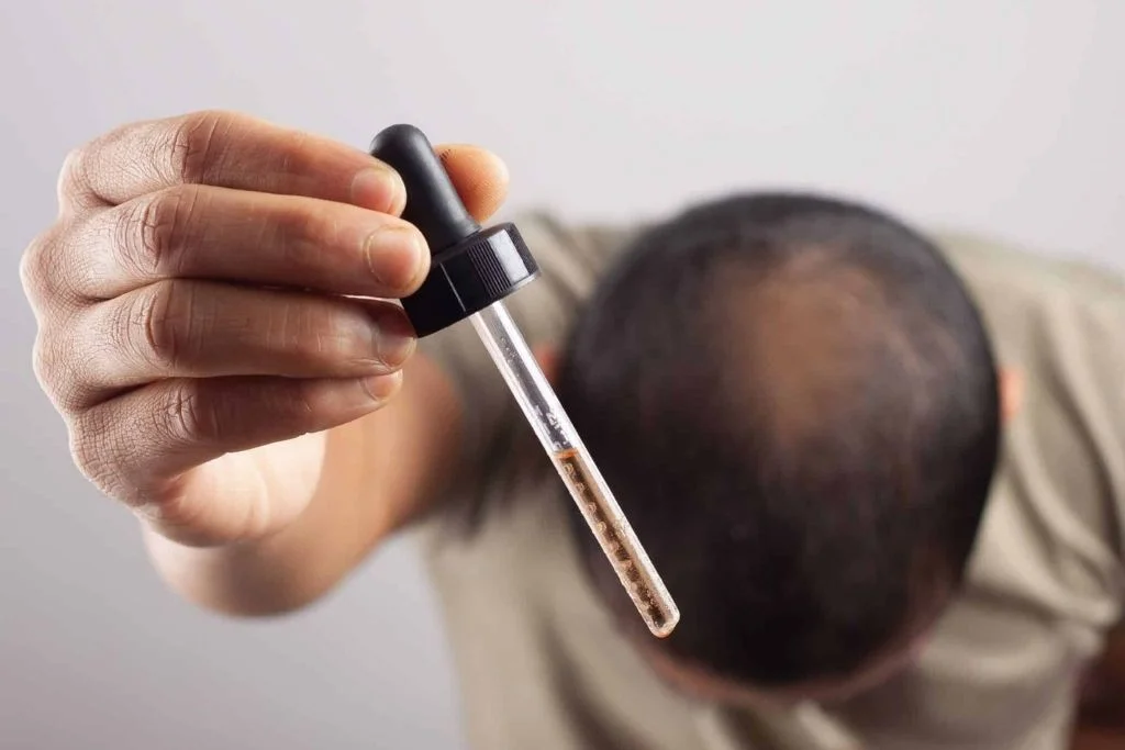 Hormonal Dengesizlik ve Kellik: Tedavi Seçenekleri
