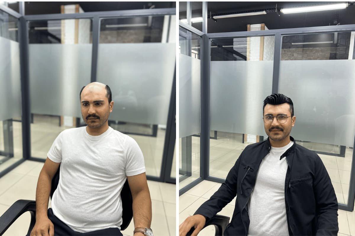 mersin en iyi protez saç