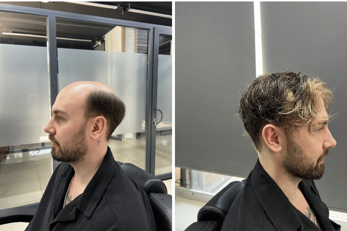 mersin protez saç hizmeti